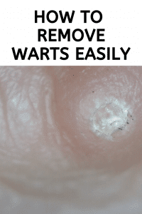 How To Remove Warts Easily - Ice Cream N Sticky Fingers