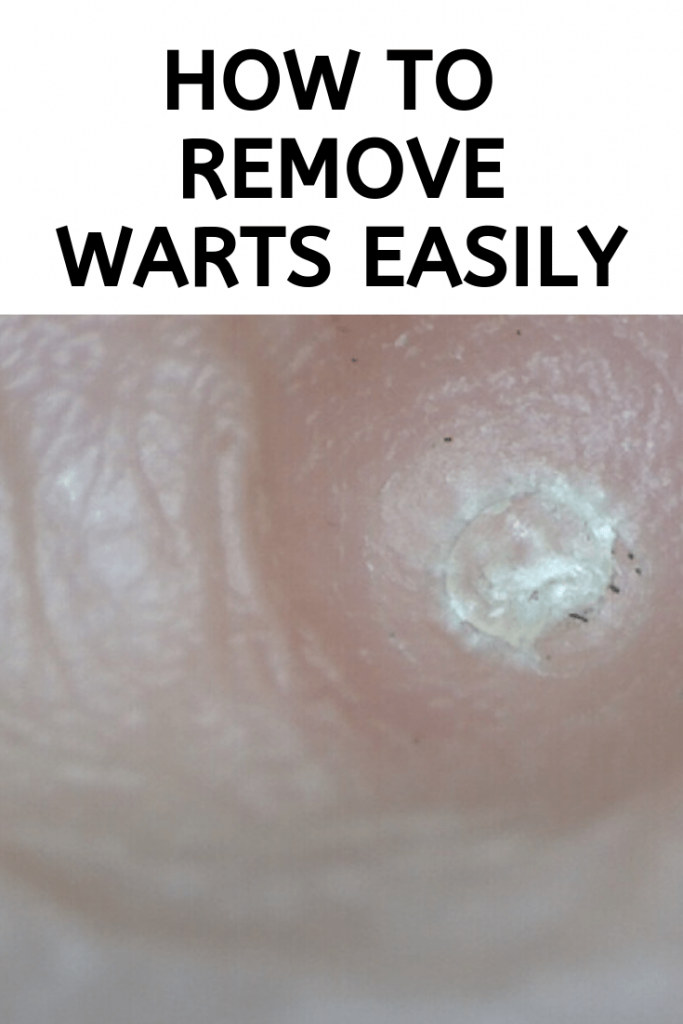 How to Remove Warts Easily