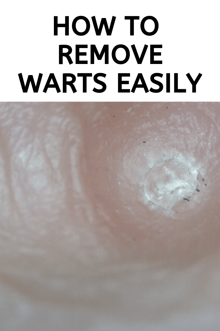 How to Remove Warts Easily Ice Cream n Sticky Fingers