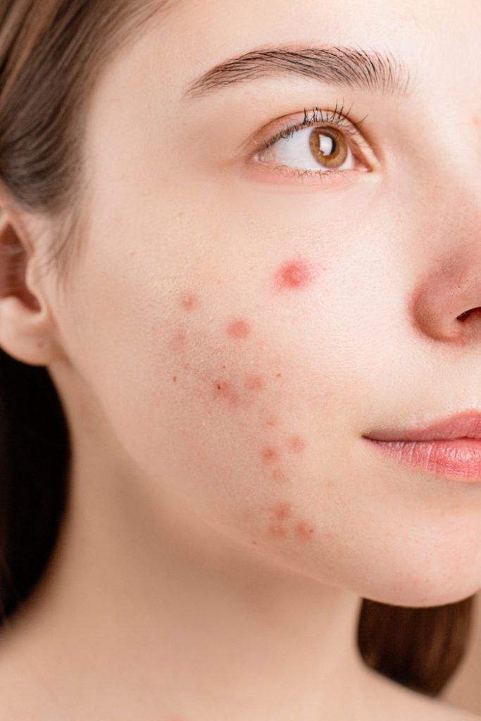 Myths about Acne Causes