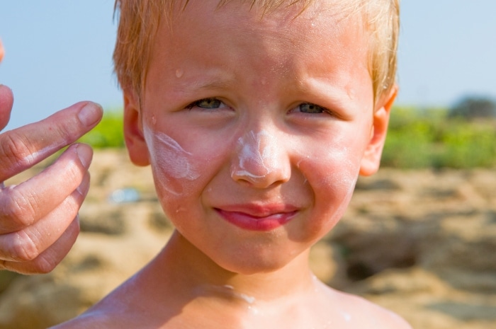 healing a sunburn naturally